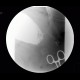 Bariatric surgery, pean: RF - Fluoroscopy